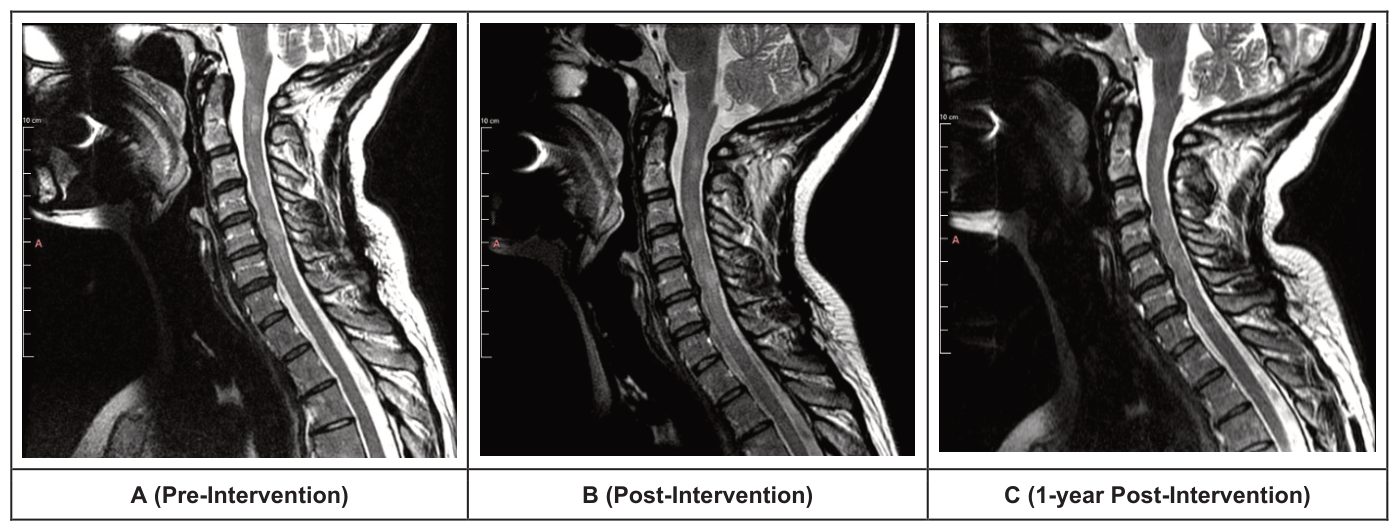 Mid-sagittal cervical MRI slices: A pre-intervention, B post-intervention, C 1-year post-intervention