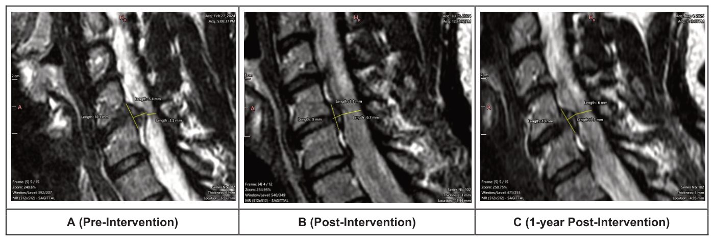 Para-sagittal MRI slices of the left-sided C5–C6 disc lesion with length measurements at three time points