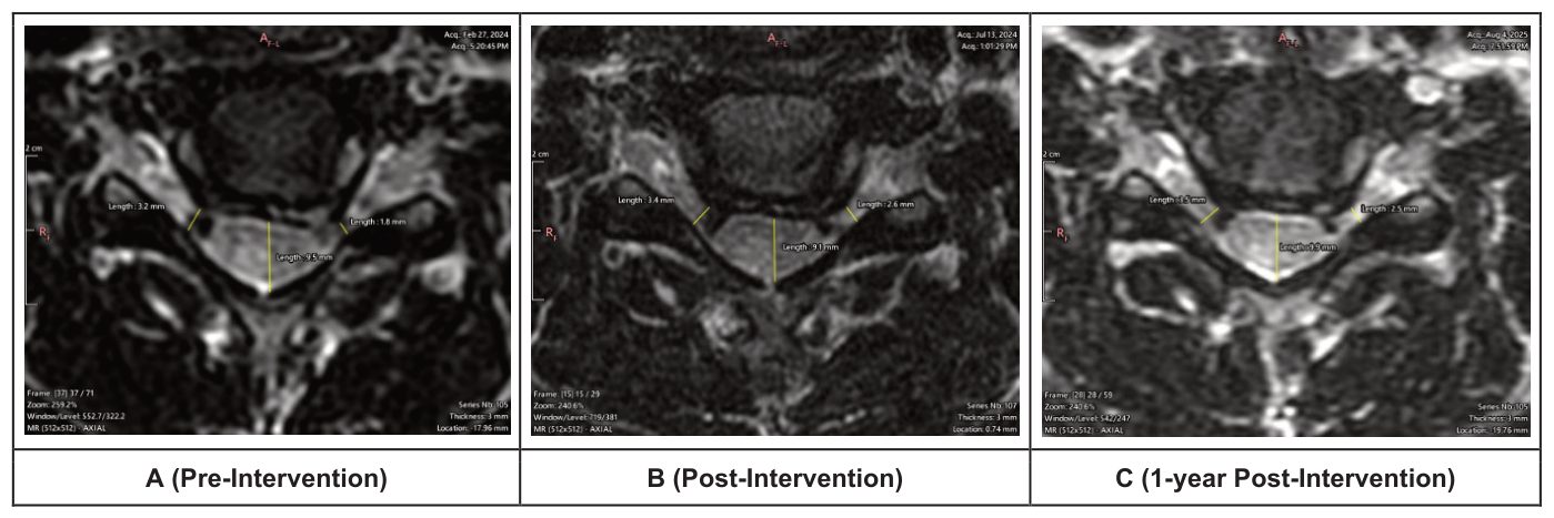 Axial MRI slices at C5-C6 with left and right foraminal gap measurements at three time points