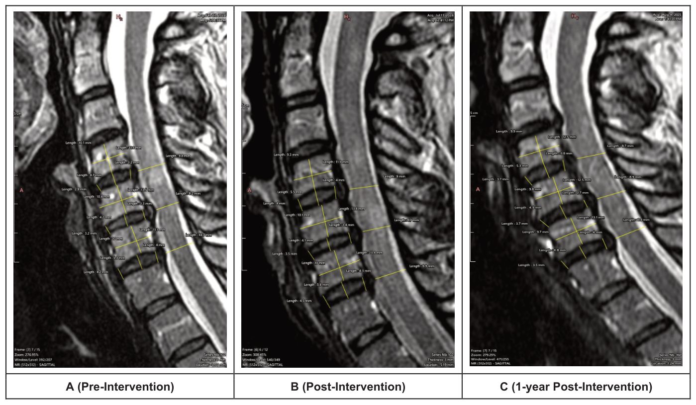 Mid-sagittal MRI slices with disc height and vertebral measurements at three time points