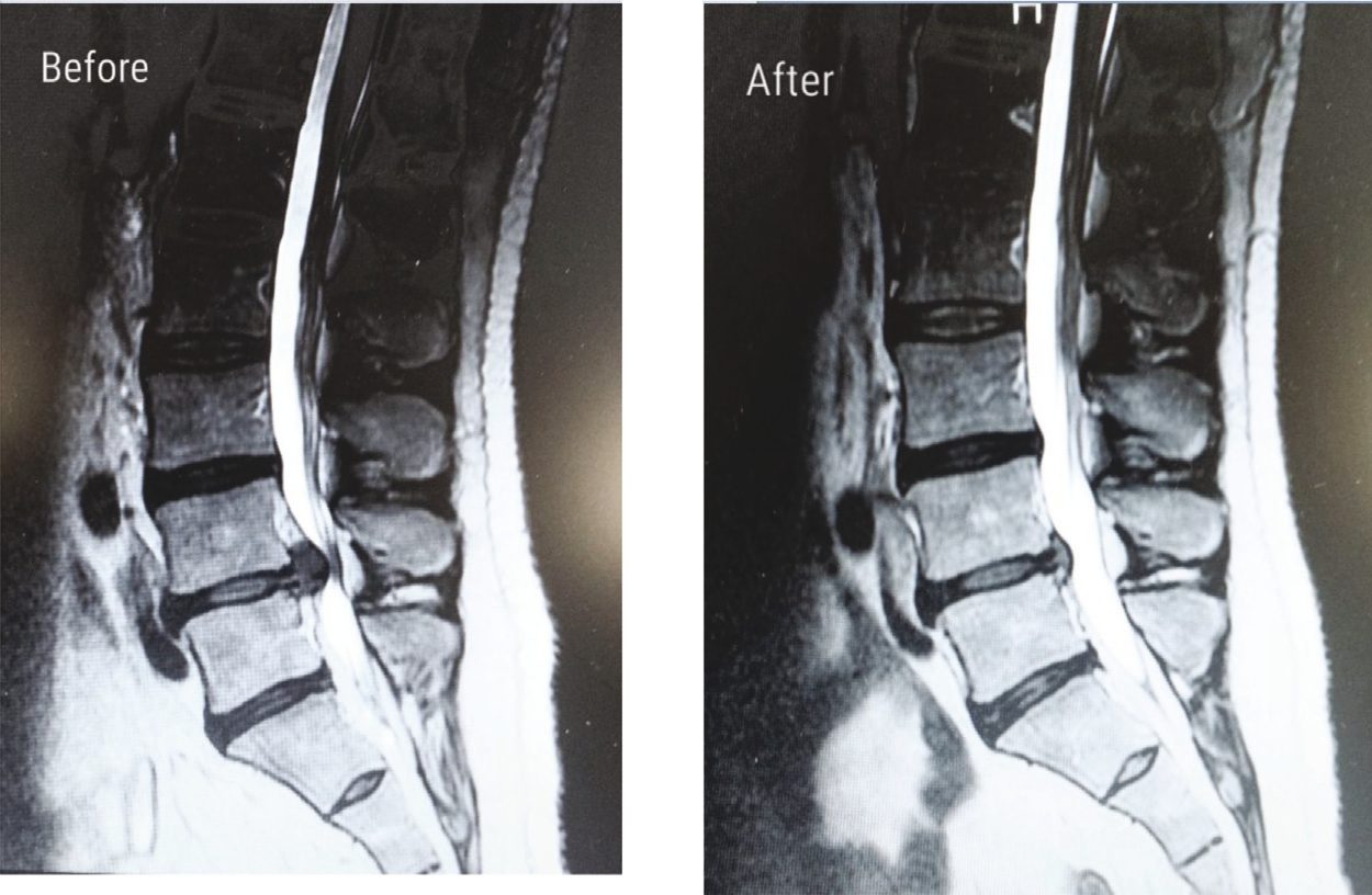 Two sagittal lumbar spine MRI scans side by side, labelled Before and After