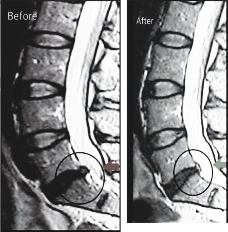 Two sagittal lumbar spine MRI scans side by side, labelled Before and After; on each scan the L5-S1 level is circled and marked with an arrow