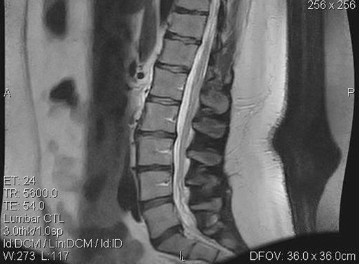 Post-treatment sagittal MRI of the lumbar spine