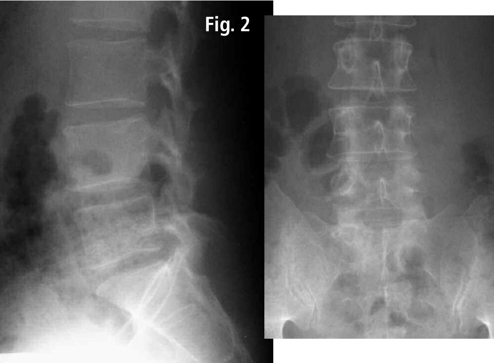 Lateral and AP weight-bearing radiographs of the lumbar spine