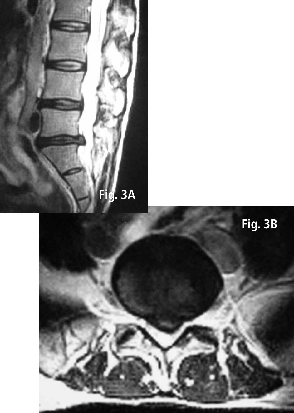T2-weighted MR images before spinal decompression: mid-sagittal (3A) and axial (3B) through L5/S1